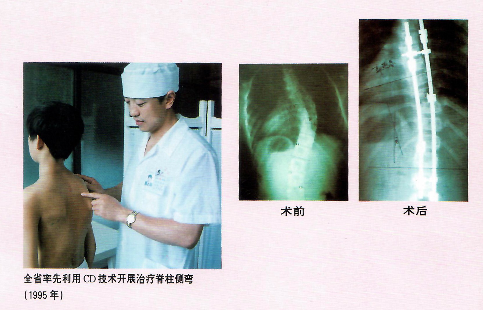 1995年，林海濱教授做了福建省第一例CD技術矯正脊椎側彎手術.jpg